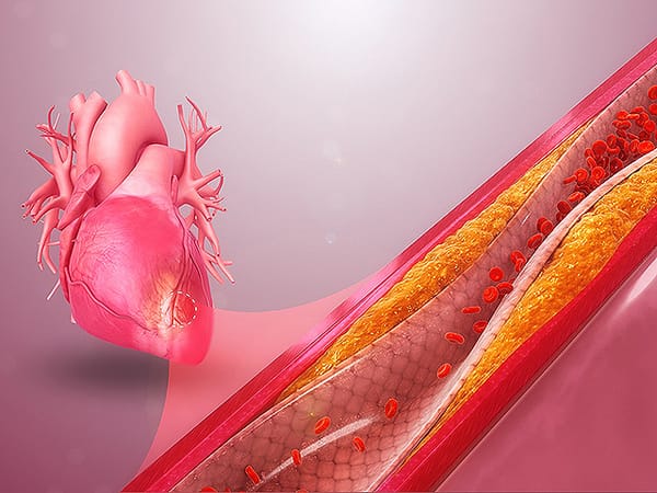 Israeli startup develops simple, accurate system for diagnosing coronary heart disease